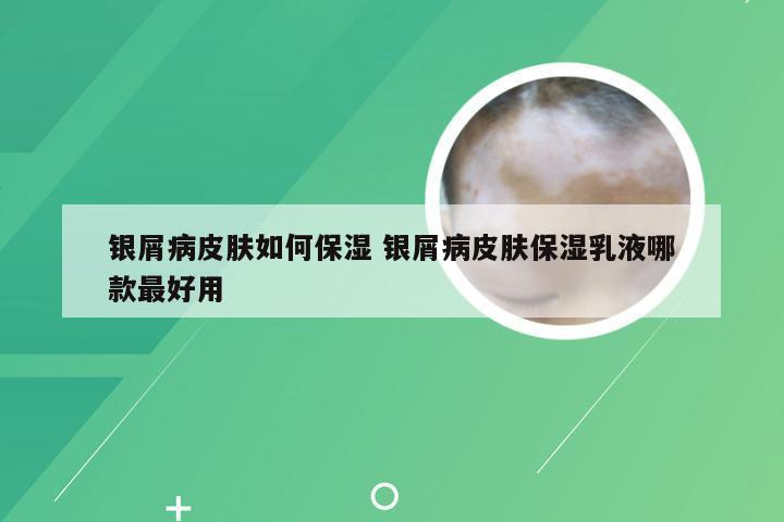 银屑病皮肤如何保湿 银屑病皮肤保湿乳液哪款最好用