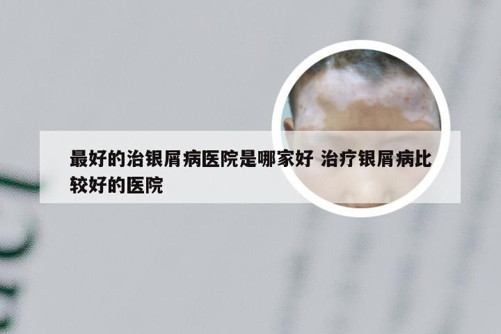 最好的治银屑病医院是哪家好 治疗银屑病比较好的医院