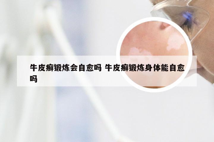 牛皮癣锻炼会自愈吗 牛皮癣锻炼身体能自愈吗
