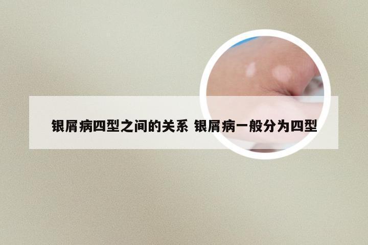 银屑病四型之间的关系 银屑病一般分为四型