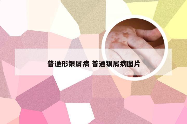 普通形银屑病 普通银屑病图片