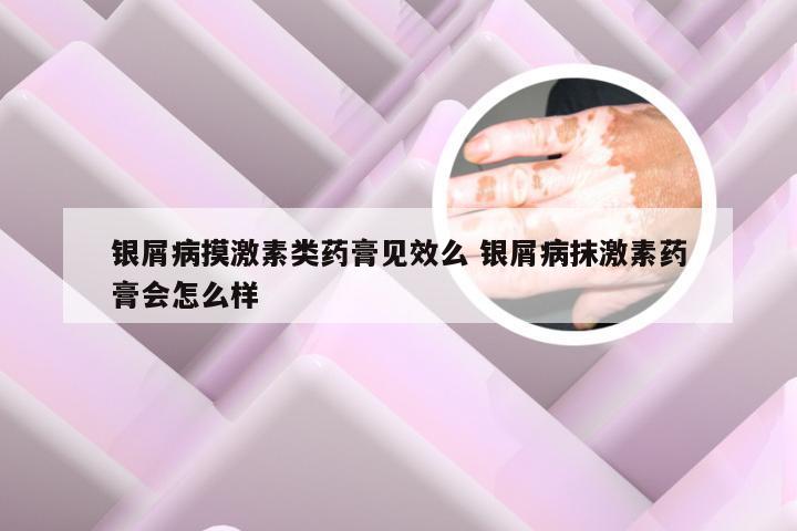 银屑病摸激素类药膏见效么 银屑病抹激素药膏会怎么样