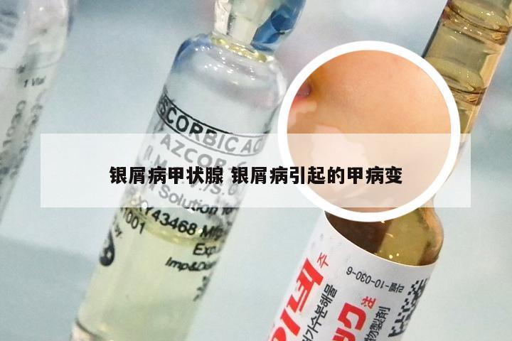 银屑病甲状腺 银屑病引起的甲病变