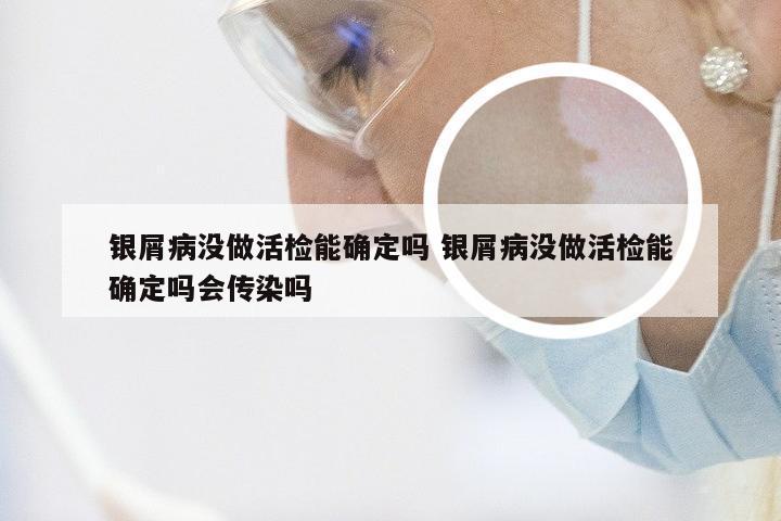 银屑病没做活检能确定吗 银屑病没做活检能确定吗会传染吗