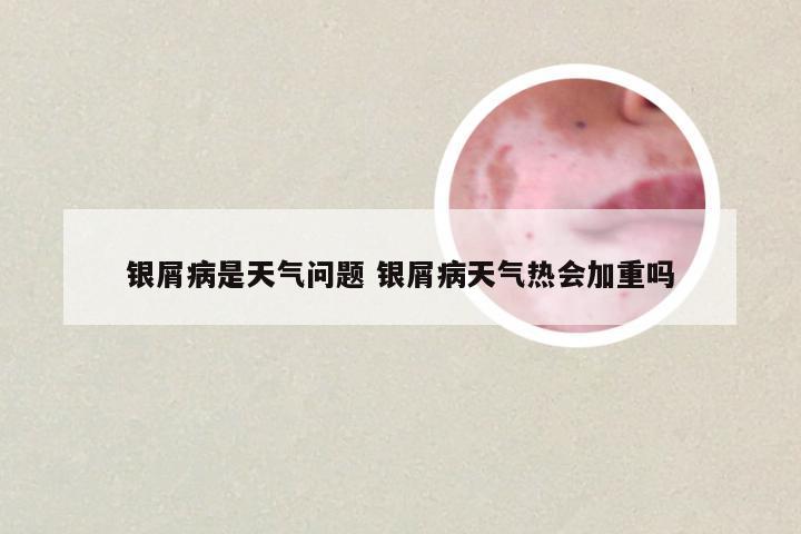 银屑病是天气问题 银屑病天气热会加重吗