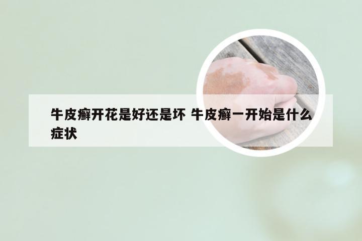 牛皮癣开花是好还是坏 牛皮癣一开始是什么症状