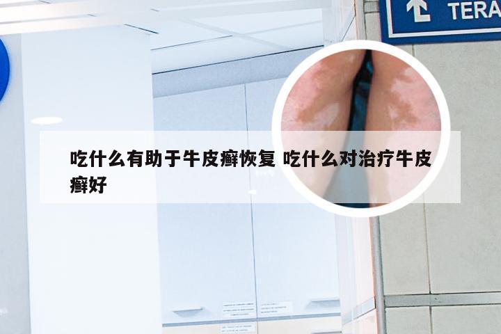 吃什么有助于牛皮癣恢复 吃什么对治疗牛皮癣好