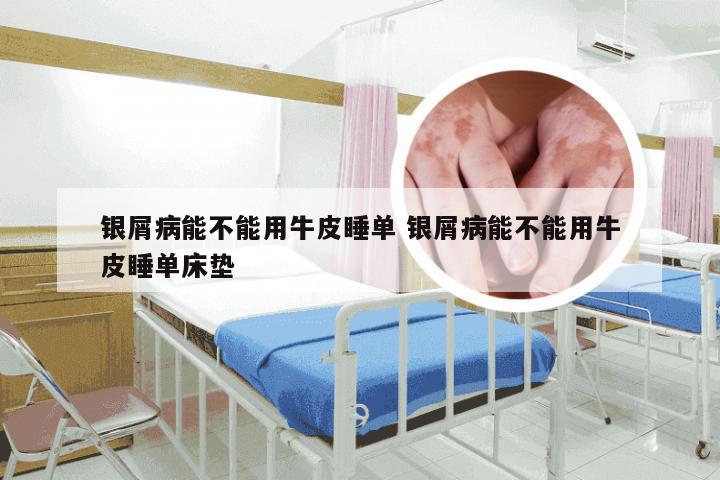 银屑病能不能用牛皮睡单 银屑病能不能用牛皮睡单床垫