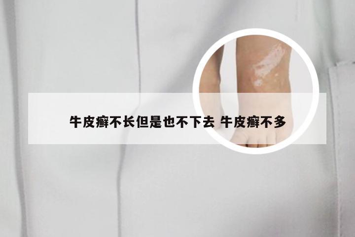 牛皮癣不长但是也不下去 牛皮癣不多